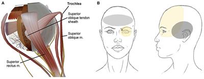 Diagnosis and Management of Trochleodynia, Trochleitis, and Trochlear Headache